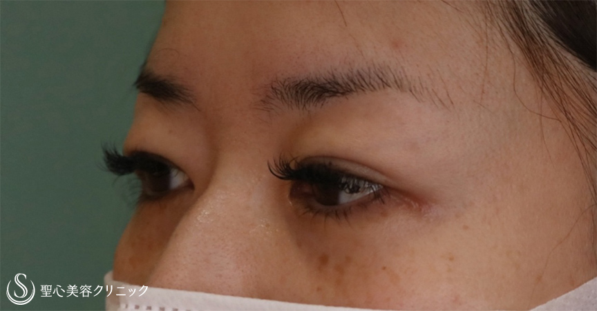【30代女性・頭痛薬が要らなくなった】眉下切開法（1ヶ月後、修正5ヶ月後） Before 