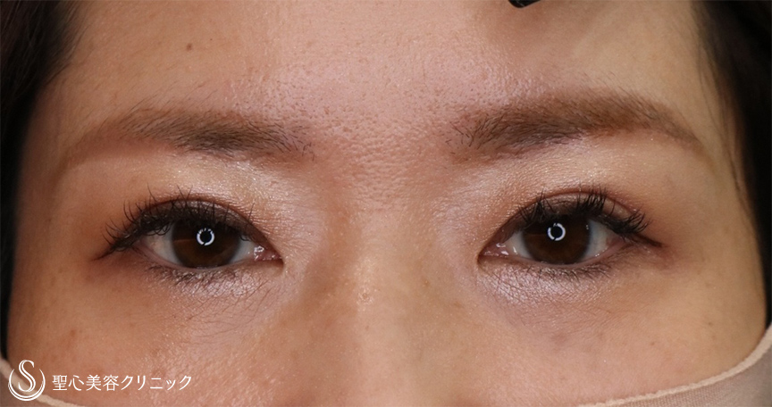 【30代女性・頭痛薬が要らなくなった】眉下切開法（1ヶ月後、修正5ヶ月後） After 