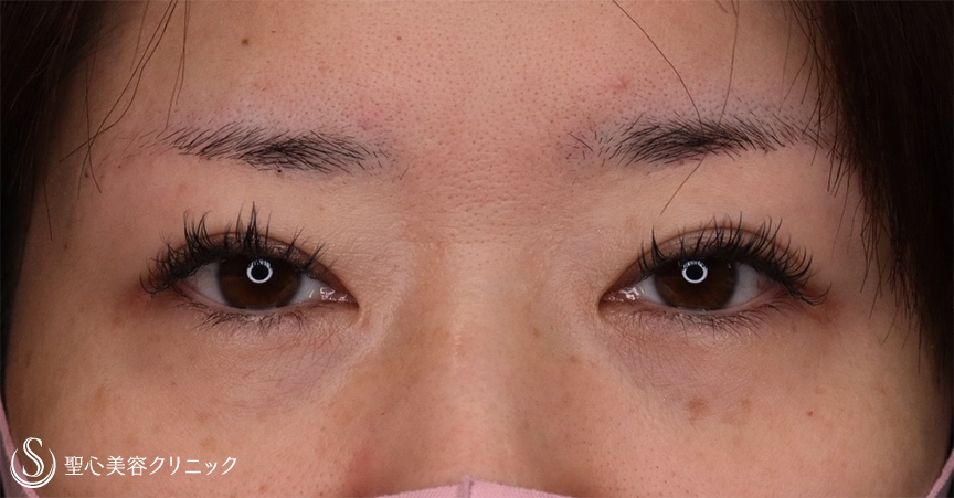 【30代女性・頭痛薬が要らなくなった】眉下切開法（1ヶ月後、修正5ヶ月後） After 