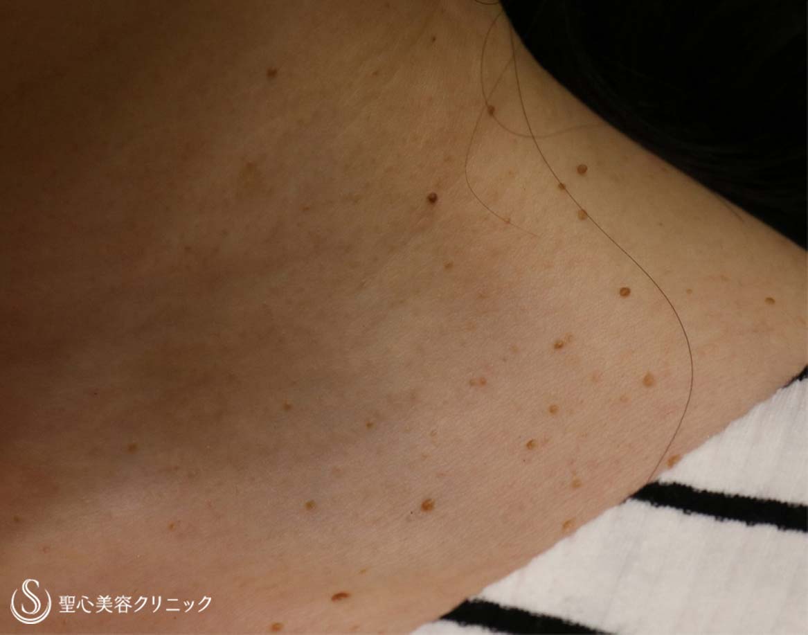 【30代女性・首イボをまとめてスッキリ】電気凝固法（1ヵ月後） Before 