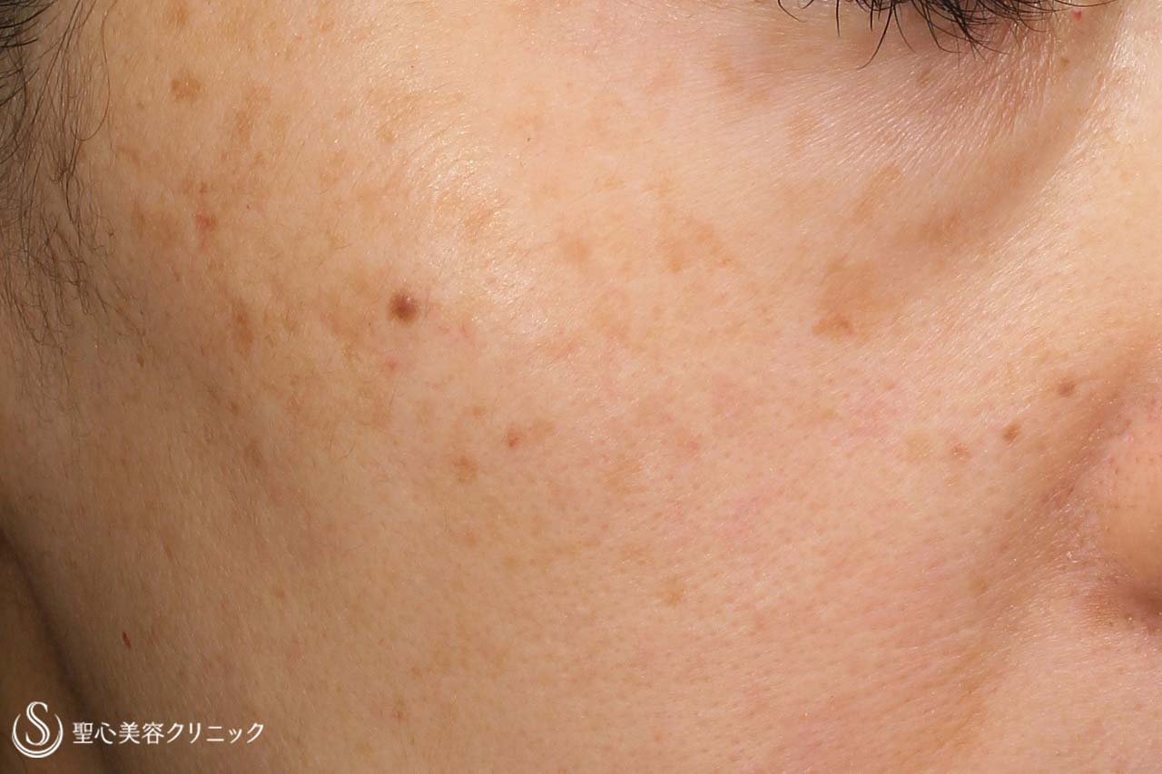【40代女性・顔を美しく】プレミアムPRP皮膚再生療法+レチノールクリーム外用（1か月後） Before 
