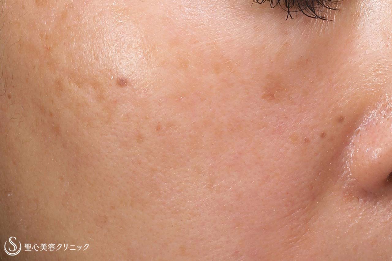 【40代女性・顔を美しく】プレミアムPRP皮膚再生療法+レチノールクリーム外用（1か月後） After 