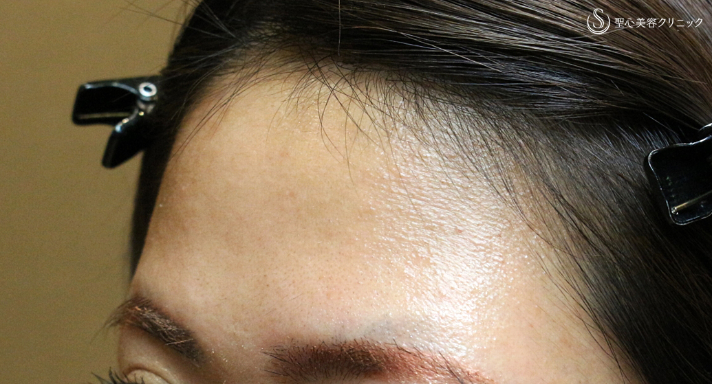 【20代女性・丸いオデコで女子力アップ】プレミアムPRP皮膚再生療法（7年後） Before 