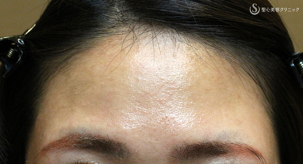【20代女性・丸いオデコで女子力アップ】プレミアムPRP皮膚再生療法（7年後） Before 