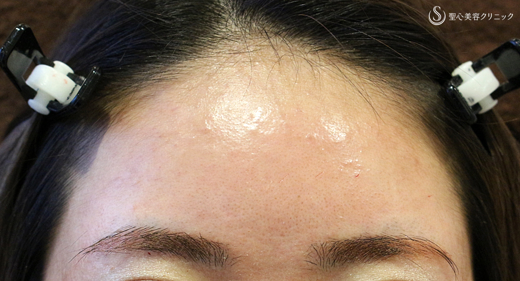 【20代女性・丸いオデコで女子力アップ】プレミアムPRP皮膚再生療法（7年後） After 