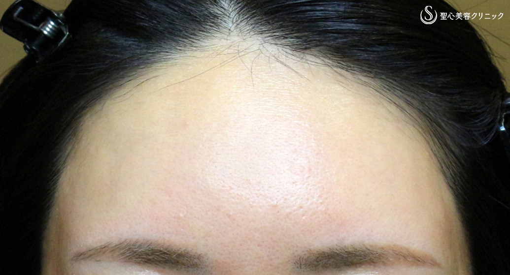 【20代女性・丸いオデコで女子力アップ】プレミアムPRP皮膚再生療法（7年後） After 