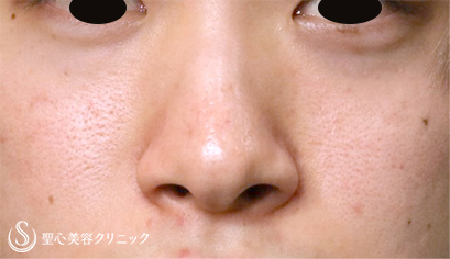 【20代男性・小鼻の横への張り出しを目立たなく】小鼻縮小術（1年後） Before 
