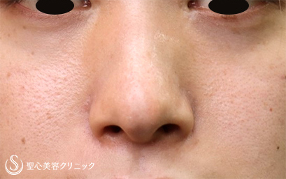 【20代男性・小鼻の横への張り出しを目立たなく】小鼻縮小術（1年後） After 