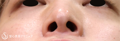 【20代男性・小鼻の横への張り出しを目立たなく】小鼻縮小術（1年後） After 