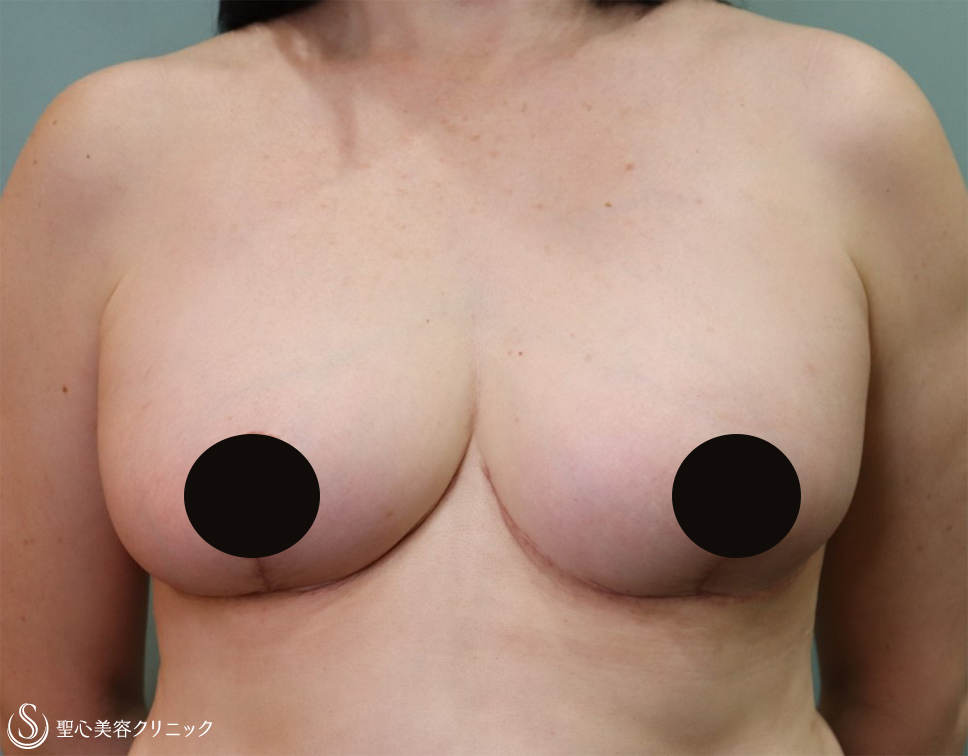 【50代女性・乳房のサイズ】乳房縮小術（1ヶ月後/1年10か月後） After 