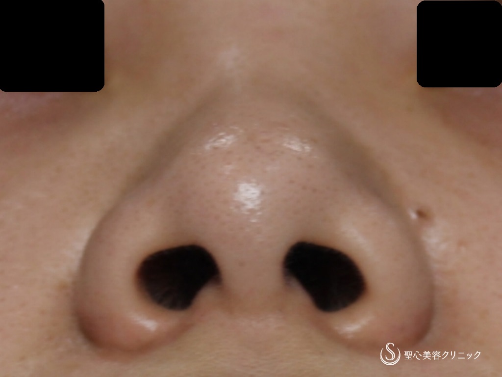 【20代女性・鼻先を綺麗に】鼻尖縮小+耳介軟骨移植後（1年半後） Before 