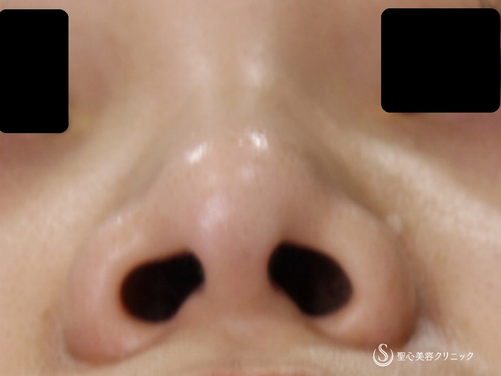【20代女性・鼻先を綺麗に】鼻尖縮小+耳介軟骨移植後（1年半後） After 