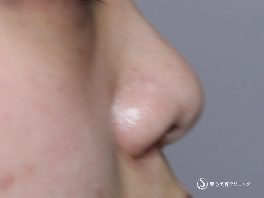 【20代女性・鼻先を綺麗に】鼻尖縮小+耳介軟骨移植後（1年半後） Before 