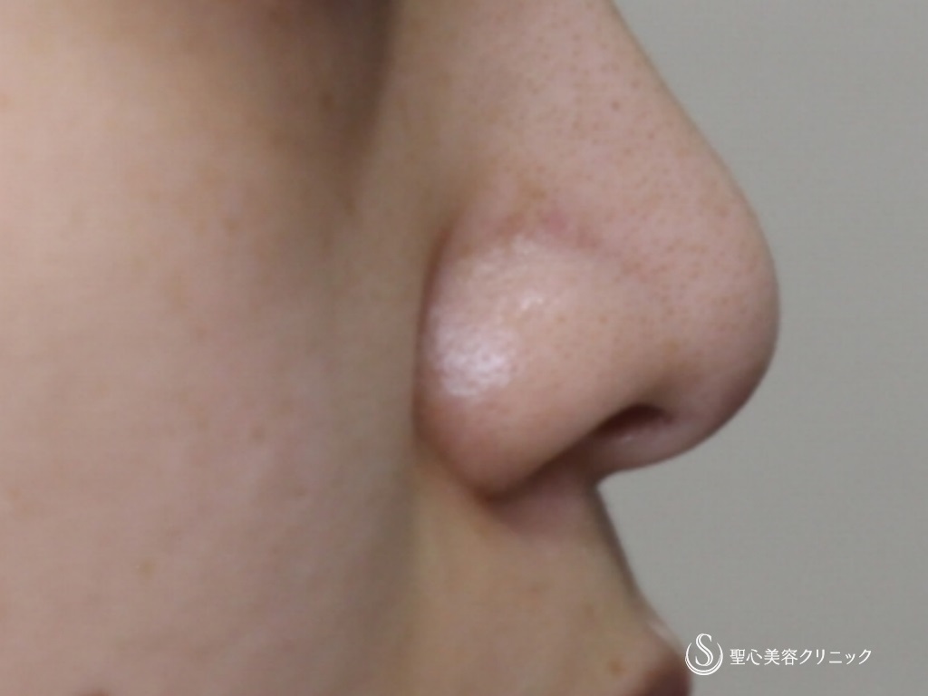 【20代女性・鼻先を綺麗に】鼻尖縮小+耳介軟骨移植後（1年半後） After 