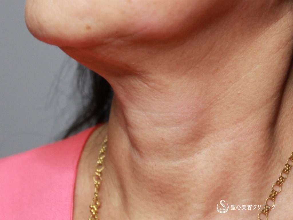 【60代女性・首の横じわの改善】プレミアムPRP皮膚再生療法（3ヶ月後） Before 