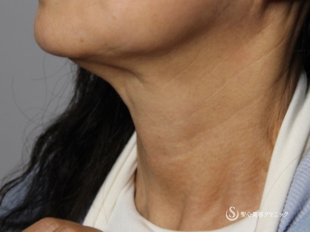 【60代女性・首の横じわの改善】プレミアムPRP皮膚再生療法（3ヶ月後） After 