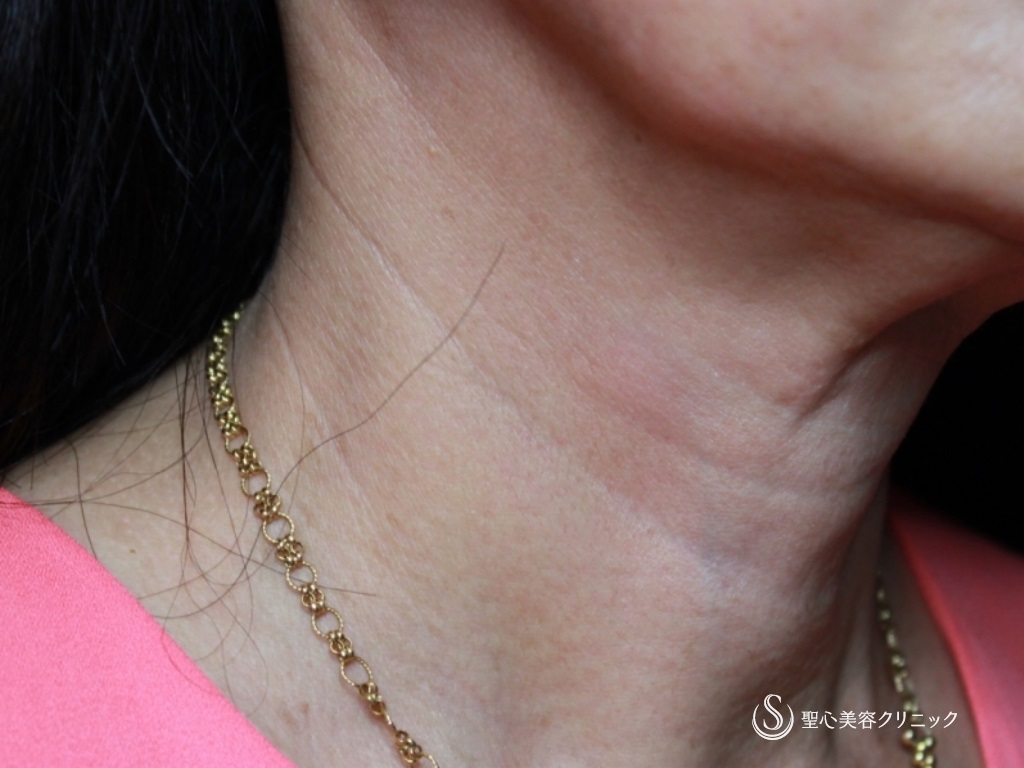 【60代女性・首の横じわの改善】プレミアムPRP皮膚再生療法（3ヶ月後） Before 