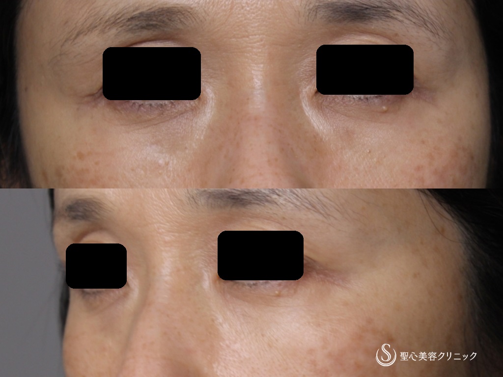 【40代女性・9年以上経過してもこの効果！！】目の下のプレミアムPRP皮膚再生療法（9年後） After 