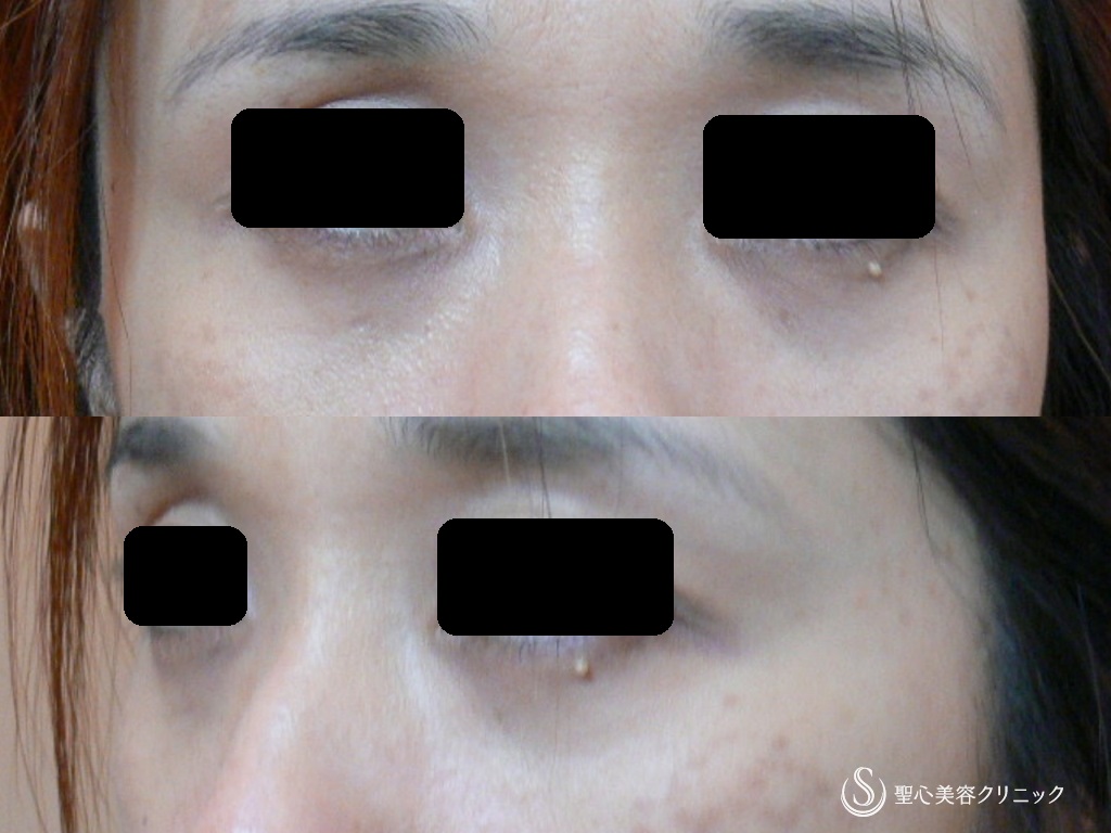 【40代女性・9年以上経過してもこの効果！！】目の下のプレミアムPRP皮膚再生療法（9年後） Before 
