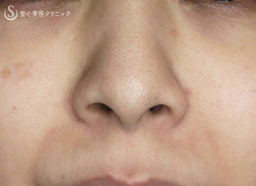 【30代女性・鼻の存在感を消す】小鼻縮小術+α法「Ver.4」（1ヶ月後） Before 