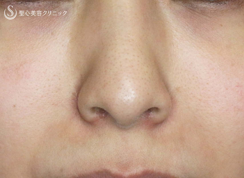 【30代女性・鼻の存在感を消す】小鼻縮小術+α法「Ver.4」（1ヶ月後） After 