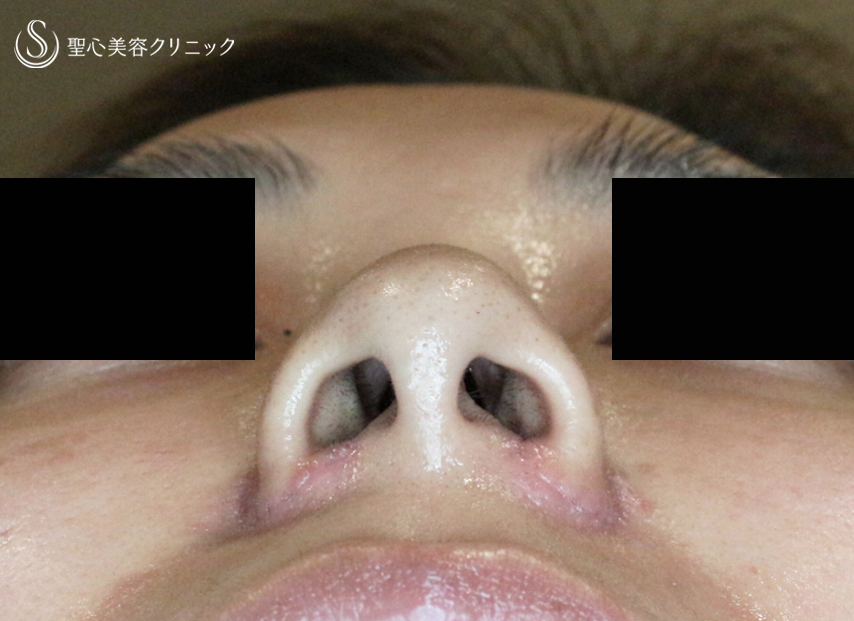 【30代女性・鼻の存在感を消す】小鼻縮小術+α法「Ver.4」（1ヶ月後） After 