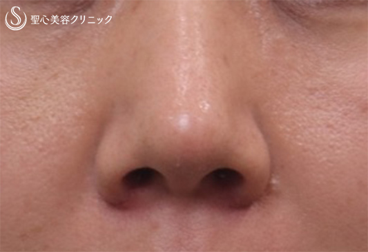 【40代女性・鼻を小さく】鼻尖縮小+鼻尖形成（耳介軟骨移植）+小鼻縮小（1週間後） After 