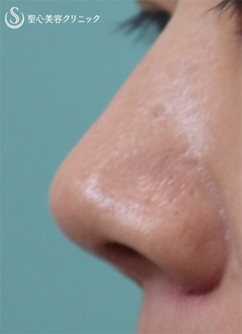 【40代女性・鼻を小さく】鼻尖縮小+鼻尖形成（耳介軟骨移植）+小鼻縮小（1週間後） After 