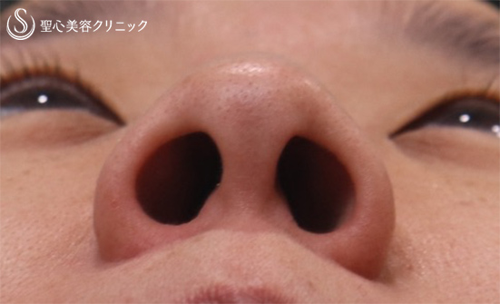 【40代女性・鼻を小さく】鼻尖縮小+鼻尖形成（耳介軟骨移植）+小鼻縮小（1週間後） Before 