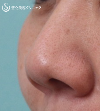 【40代女性・鼻を小さく】鼻尖縮小+鼻尖形成（耳介軟骨移植）+小鼻縮小（1週間後） Before 