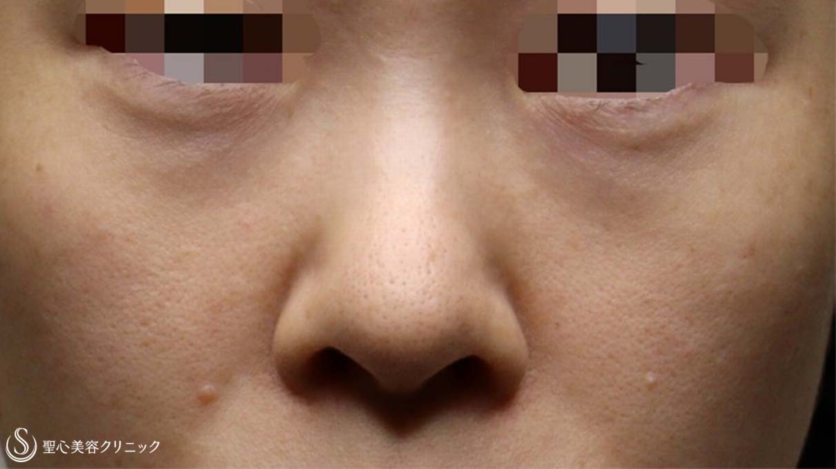 【30代女性・切らない目の下のクマ治療】プレミアムPRP皮膚再生療法（2ヶ月後） Before 