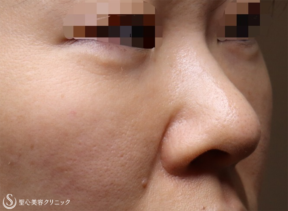 【30代女性・切らない目の下のクマ治療】プレミアムPRP皮膚再生療法（2ヶ月後） After 