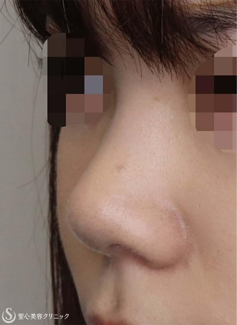 【20代女性・お鼻をナチュラルにスッキリ！！】Gメッシュ＋鼻尖縮小＋鼻尖形成（耳介軟骨移植）（2ヶ月後） Before 