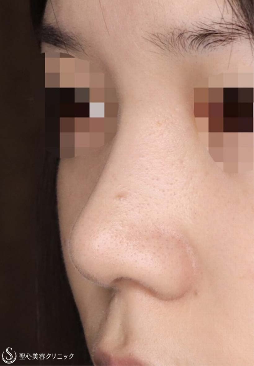 【20代女性・お鼻をナチュラルにスッキリ！！】Gメッシュ＋鼻尖縮小＋鼻尖形成（耳介軟骨移植）（2ヶ月後） After 