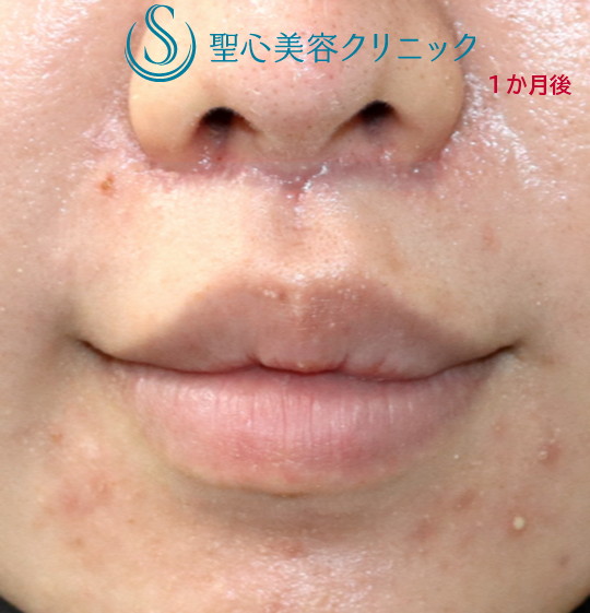 【20代女性・鼻下短縮術】リップリフト（1ヶ月後） After 