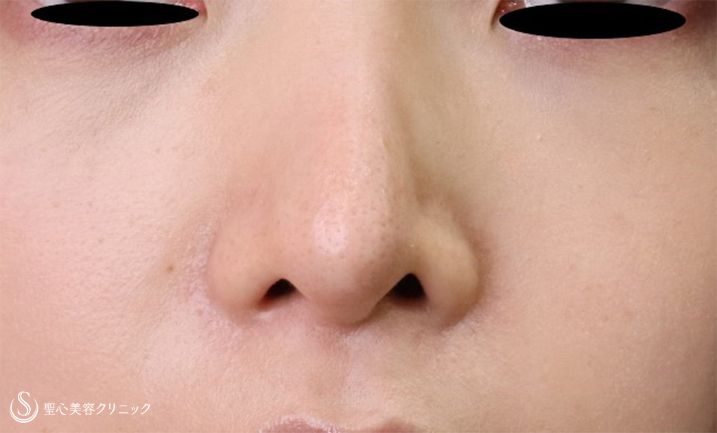 【30代女性・鼻孔の形】鼻孔縁下降術（1週間後） Before 