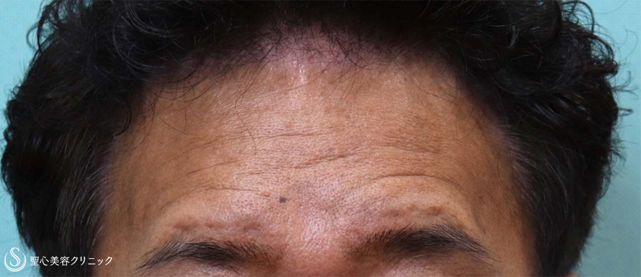 【50代男性・額のしわにプレミアムPRP】プレミアムPRP皮膚再生療法（1年後） Before 