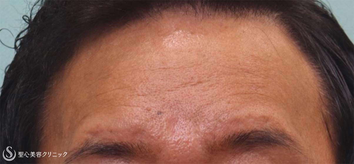 【50代男性・額のしわにプレミアムPRP】プレミアムPRP皮膚再生療法（1年後） After 