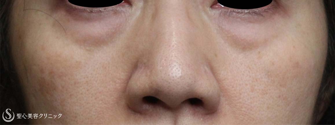 【50代女性・目の下のくまを改善】経結膜下脱脂、プレミアムPRP皮膚再生療法（6ヶ月後） Before 