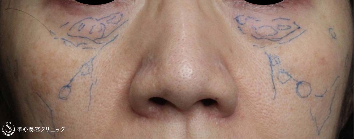 【50代女性・目の下のくまを改善】経結膜下脱脂、プレミアムPRP皮膚再生療法（6ヶ月後） Before 