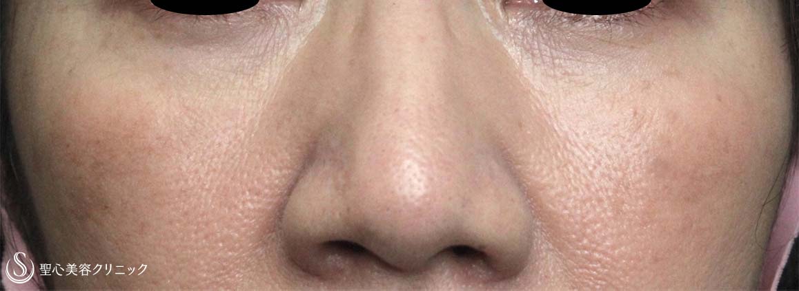 【50代女性・目の下のくまを改善】経結膜下脱脂、プレミアムPRP皮膚再生療法（6ヶ月後） After 
