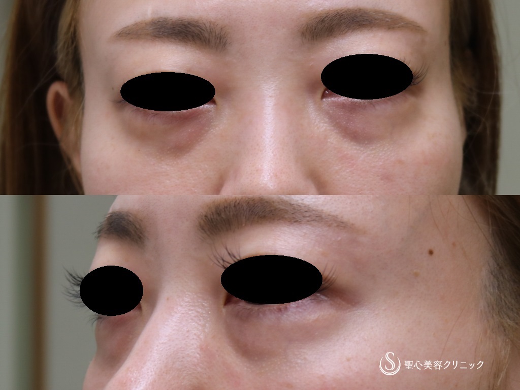【30代女性・目の下のたるみ、クマ治療】プレミアムPRP皮膚再生療法（術後1年） Before 