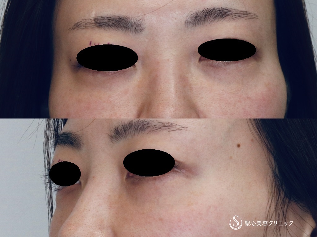 【30代女性・目の下のたるみ、クマ治療】プレミアムPRP皮膚再生療法（術後1年） After 