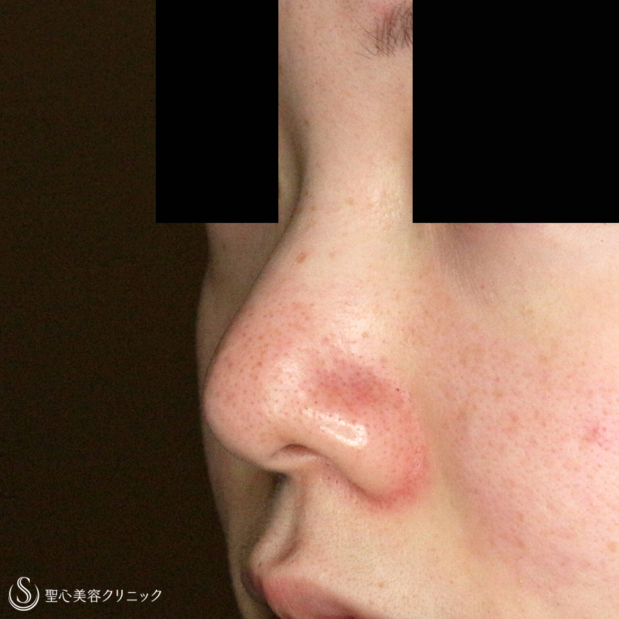 【20代女性・画期的なダンゴ鼻の治療＆鼻尖延長】3D鼻尖用・PCLドーム（1年4ヶ月後） After 