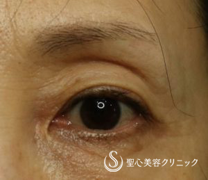 【60代女性・目の上のくぼみ】プレミアムPRP皮膚再生療法（2年後） Before 