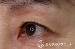 【60代女性・目の上のくぼみ】プレミアムPRP皮膚再生療法（2年後） After 