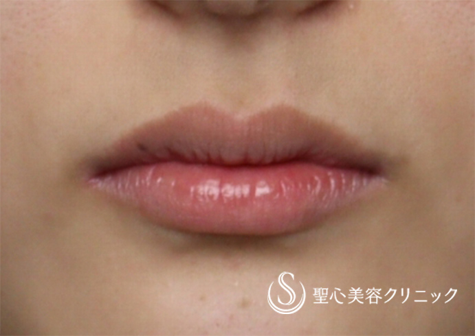 【女性・バランスの良いM字の唇に】プレミアム口角挙上術（3ヶ月後） Before 