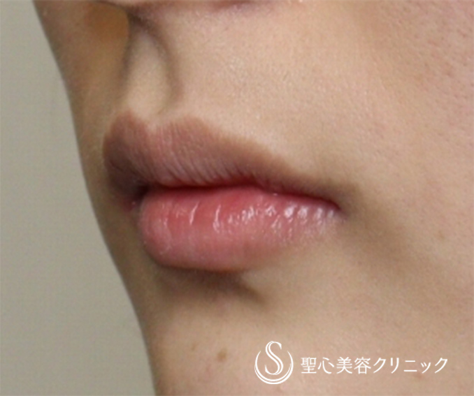 【女性・バランスの良いM字の唇に】プレミアム口角挙上術（3ヶ月後） Before 