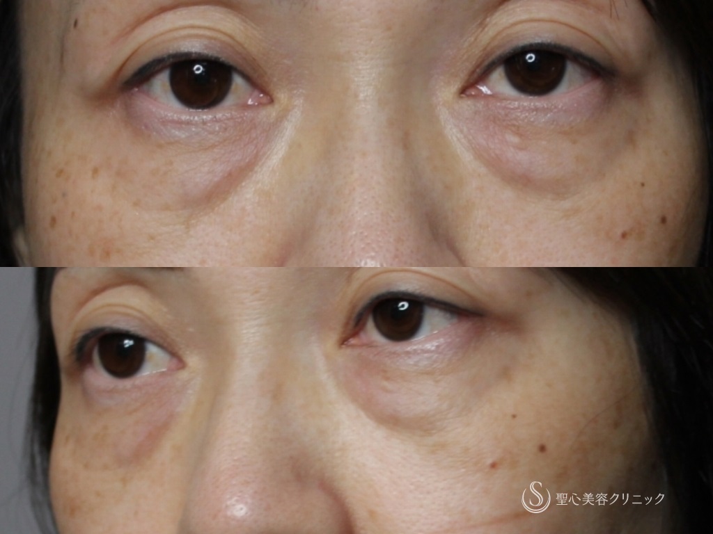 【40代女性・注射だけで目周りを若々しく！！】プレミアムPRP皮膚再生療法（1年後） Before 
