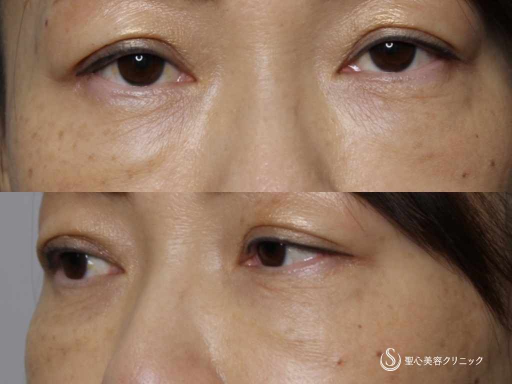 【40代女性・注射だけで目周りを若々しく！！】プレミアムPRP皮膚再生療法（1年後） After 